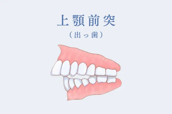 上顎前突