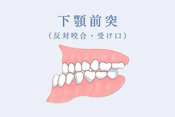 下顎前突