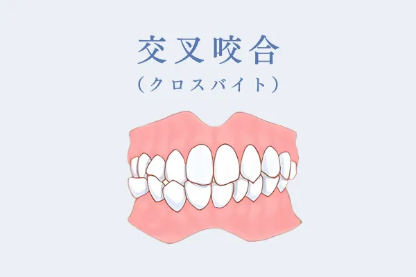 交叉咬合